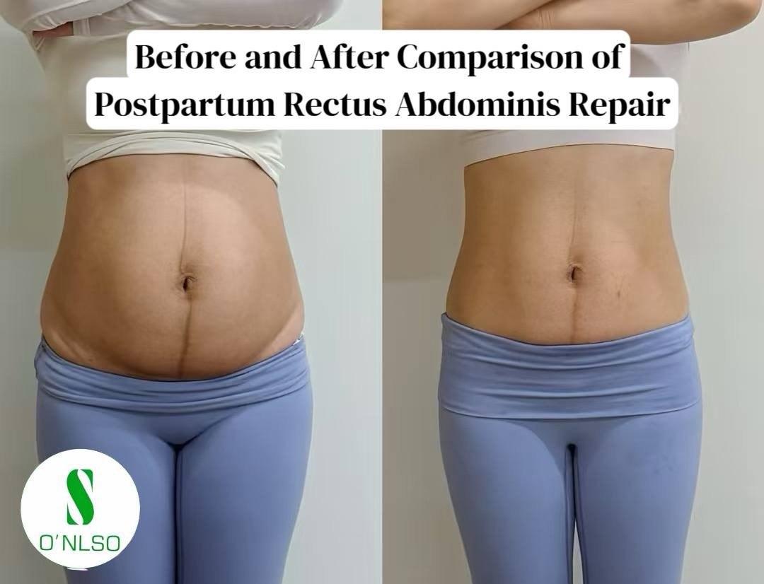 Postpartum abdominal before-and-after comparison supplied by ONLSO