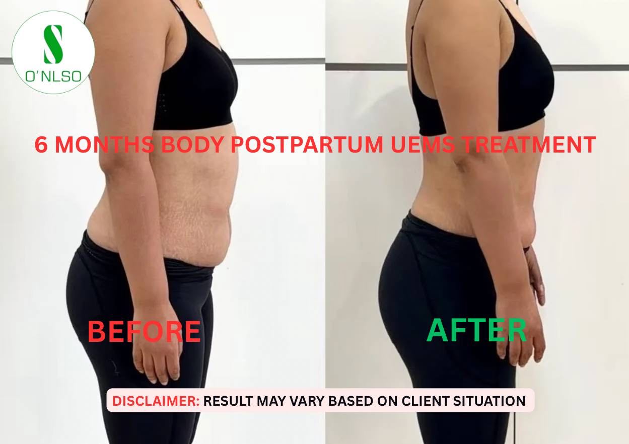 UEMS postpartum side-view comparison supplied by ONLSO